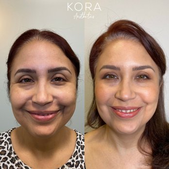 Kora Aesthetics - Advanced injection patterns using wrinkle relaxers (like Botox and Dysport) will soften fine lines and create a lifted appearance. - Medical Spas Near Me - Scottsdale, Arizona Kora Aesthetics - Advanced injection patterns using wrinkle relaxers (like Botox and Dysport) will soften fine lines and create a lifted appearance. - Medical Spas Near Me - Scottsdale, Arizona