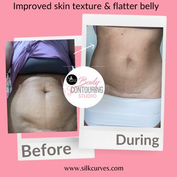 Silk Curves Body Contouring - New Orleans Non Surgical Treatments for Belly fat and scar reduction. - Body Contouring Near Me - New Orleans, Louisiana Silk Curves Body Contouring - New Orleans Non Surgical Treatments for Belly fat and scar reduction. - Body Contouring Near Me - New Orleans, Louisiana