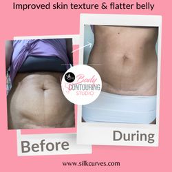 New Orleans Non Surgical Treatments for Belly fat and scar reduction.