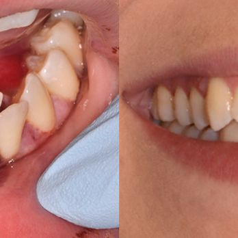 Capital Center - "I was hit by a bus. My front teeth and jaw are broken." Repair of fractures, bone reconstruction and implant supported bridge. - Oral Surgeons Near Me - Washington, DC, District of Columbia
