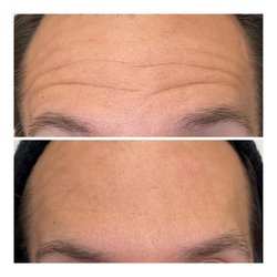 Aesthoria Aesthetics Medical Spa - Before and after of daxxify treatment to soften forehead lines.