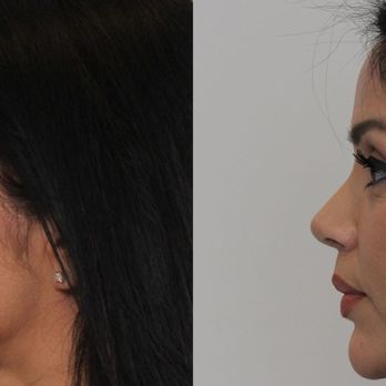 Eos Rejuvenation - Before and After - Side Profile - Cosmetic Surgeons Near Me - Beverly Hills, California