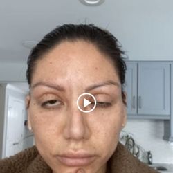 Michael A Epstein, MD - Few months post op