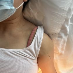 North Peninsula Acupuncture - Shoulder pain