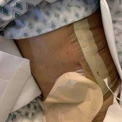 Rio Vista Surgical Associates - A Total Abdominal Colectomy and Ileostomy removing all my large Intestines for what he called Malignant Cancer.