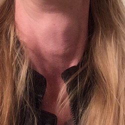 Crevello Albert J MD - Three days later a lot of swelling is gone down still hard to breathe.