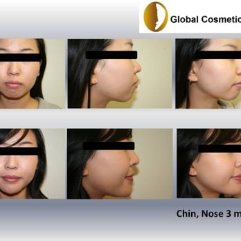 Global Cosmetic Clinic - See the changes? - Cosmetic Surgeons Near Me - Santa Clara, California Global Cosmetic Clinic - See the changes? - Cosmetic Surgeons Near Me - Santa Clara, California