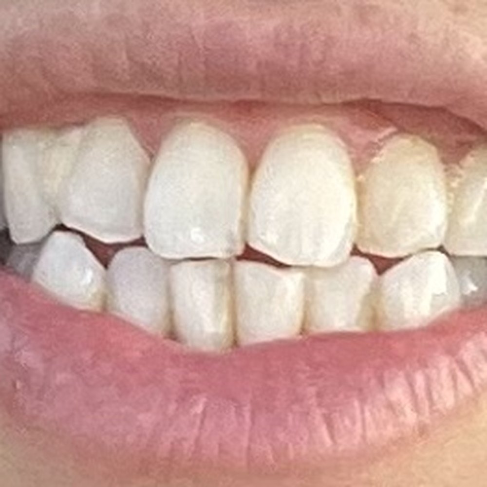 Cedar Smiles Dentistry - Before :( - General Dentistry Near Me - Bellflower, California
