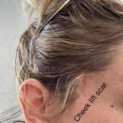 MAE Plastic Surgery - Huge scar