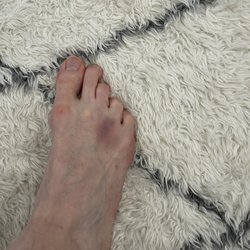 Foot & Body Reflexology - A bruise from "Tina" who roughed me up like I owed her money.