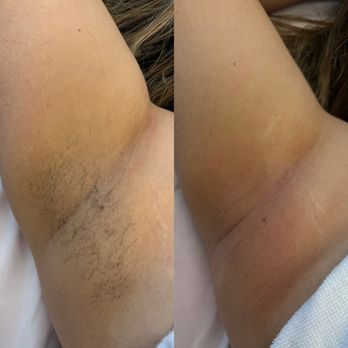 Flora Esthetics - Before & After monthly maintenance under arm sugaring - Sugaring Near Me Flora Esthetics - Before & After monthly maintenance under arm sugaring - Sugaring Near Me