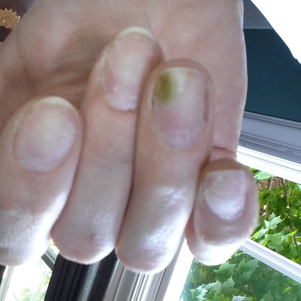 Jolie Nails and Spa - Green fungus from unsanitary tools and improper nail placement - Nail Salons Near Me - Seattle, Washington Jolie Nails and Spa - Green fungus from unsanitary tools and improper nail placement - Nail Salons Near Me - Seattle, Washington
