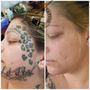 Photo of Reno Tattoo Removal