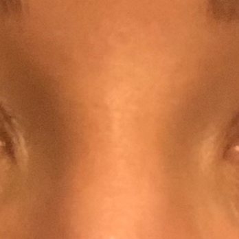 SharpeVision MODERN LASIK & LENS - Uneven pupils from ICL procedure - Laser Eye Surgery/Lasik Near Me - Bellevue, Washington SharpeVision MODERN LASIK & LENS - Uneven pupils from ICL procedure - Laser Eye Surgery/Lasik Near Me - Bellevue, Washington