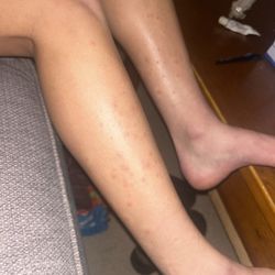 CK Nails & Spa - Rash from pedicure