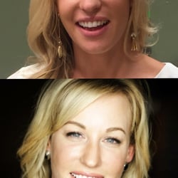 Mobley MD Facial Plastic Surgeon - Before top, after bottom