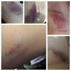 El Proyecto Del Barrio Family Health Care Clinic - Got bruised after getting blood out