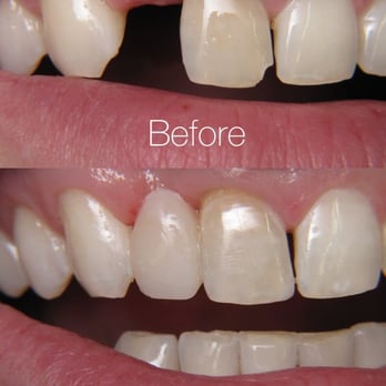 Kevin Shearer, DDS - This patient lost a tooth in an accident, so we decided to do a one-appointment composite bridge due to finances, and this is the result. - Cosmetic Dentists Near Me - Mount Shasta, California Kevin Shearer, DDS - This patient lost a tooth in an accident, so we decided to do a one-appointment composite bridge due to finances, and this is the result. - Cosmetic Dentists Near Me - Mount Shasta, California