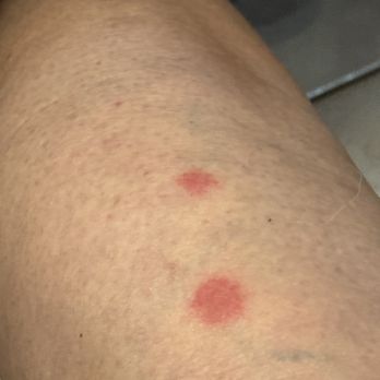 Quality Inn And Conference Center - Bed Bug bite! - Hotels Near Me - Springfield, Ohio Quality Inn And Conference Center - Bed Bug bite! - Hotels Near Me - Springfield, Ohio