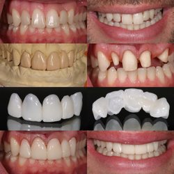 Gary S Solnit, DDS MS - Teamwork! Esthetic design and wax up by Dr. Tibor Forai, preparations and temporaries by Dr. Gary Solnit and amazing staff. #cosmeticdentist