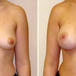 Wellesley Cosmetic Surgery - A young woman before and 2 months after a breast augmentation with silicone implants. 34B to C/D. $7650