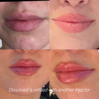 Nurse Angella - Lips refilled with another injector. Top lip is filled in the correct areas underneath and lifted upwards not outwards - Nurse Practitioner Near Me - Beverly Hills, California