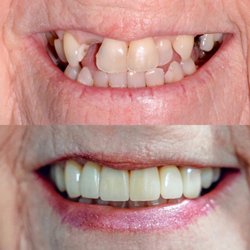 Dental Studio West - Before and after dental results at Dental Studio West! Dentist in Cincinnati, OH.