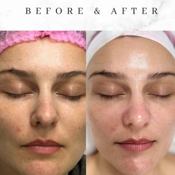 Skin Expert - Deep pore facial - Aestheticians Near Me - Huntington Beach, California Skin Expert - Deep pore facial - Aestheticians Near Me - Huntington Beach, California