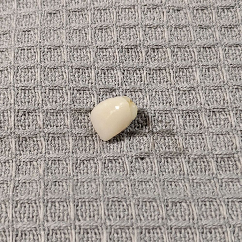 Aspen Dental - Biddeford, ME - Broken crown - Oral Surgeons Near Me - Biddeford, Maine Aspen Dental - Biddeford, ME - Broken crown - Oral Surgeons Near Me - Biddeford, Maine