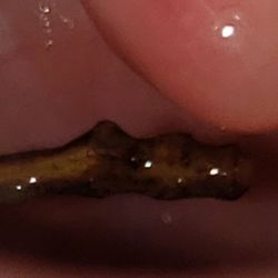 Emergency Room at Arizona General Hospital - Surprise - Basil stem stuck in back of throat.