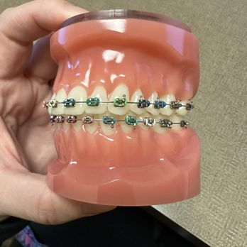 Edmonds Orthodontics - Example of metal brackets and color options for the bands - Orthodontists Near Me - Edmonds, Washington Edmonds Orthodontics - Example of metal brackets and color options for the bands - Orthodontists Near Me - Edmonds, Washington