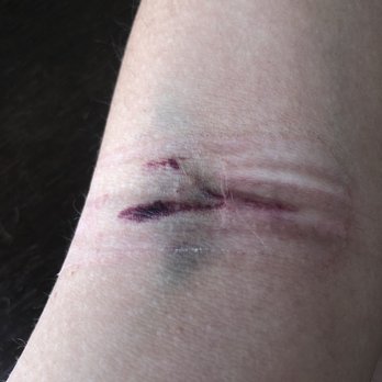 Mend Urgent Care - Poor technique from minimal supervision and inadequately trained staff resulting in blown vein and inability to obtain labs that day. - Urgent Care Near Me - Los Angeles, California Mend Urgent Care - Poor technique from minimal supervision and inadequately trained staff resulting in blown vein and inability to obtain labs that day. - Urgent Care Near Me - Los Angeles, California