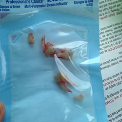 IOWA Oral and Maxillofacial Surgeons,PC - Pretty intact wisdom tooth extraction!