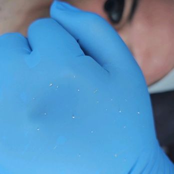Kua Esthetics - Post extractions - Skin Care Near Me - Honolulu, Hawaii