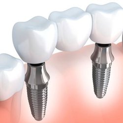 Implant Dental - Implant Dental | Plattsburgh, NY