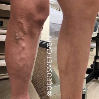 OC Cosmetic and Vein Center - Endoveous Laser Ablation - Medical Spas Near Me - Brea, California OC Cosmetic and Vein Center - Endoveous Laser Ablation - Medical Spas Near Me - Brea, California