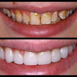 Rivertop Dental - Smile MakeOver Before-After
