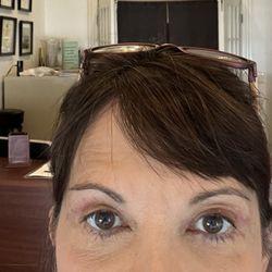 Zhong Ye, MD - chicago Anti-Aging Institute - Immediately after stitch removal.