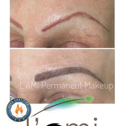 Our Doctor specializes in Unwanted tattoos and correction.