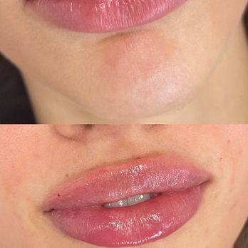 Dr Michael Zacharia - Lip filler before and after - Cosmetic Surgeons Near Me - Double Bay, NSW Dr Michael Zacharia - Lip filler before and after - Cosmetic Surgeons Near Me - Double Bay, NSW