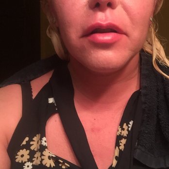 Z Place SalonSpa - This is how red I looked after the allergic reaction - Massage Near Me - Kennewick, Washington Z Place SalonSpa - This is how red I looked after the allergic reaction - Massage Near Me - Kennewick, Washington