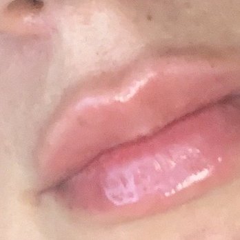 Parkhurst Luxe Medspa - After lip filler - Medical Spas Near Me - San Antonio, Texas