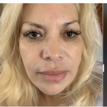 Botox Boutique - Picture after botox - Skin Care Near Me - Sunnyvale, California