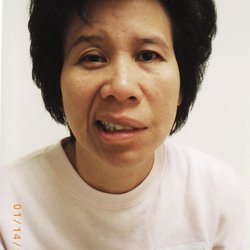 Peter Hien Vo - Before Acupuncture
