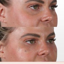 AdmireMD Plastic Surgery + Skin Clinic - PRF EZ Gel Under Eye Regenerative Therapy