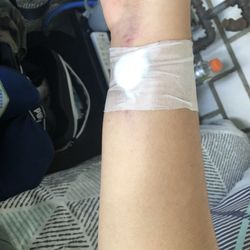 Hospital de las Californias - Bump from burst vein