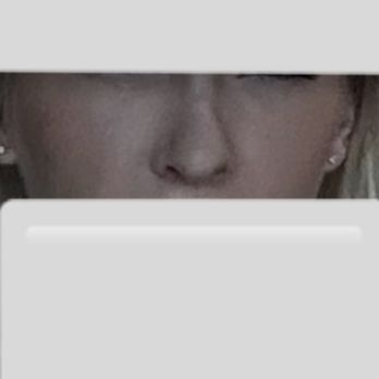 Folsom Plastic Surgery - This photo is flipped so the "right side" of my nose in this photo is actually my left side - Laser Hair Removal Near Me - Folsom, California Folsom Plastic Surgery - This photo is flipped so the "right side" of my nose in this photo is actually my left side - Laser Hair Removal Near Me - Folsom, California