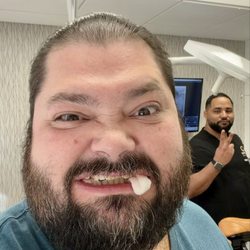 Synergy Dental Implant & Oral Surgery Center Reseda - Lost all my wisdom