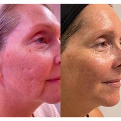 Puritie Spa & Studios - 3 Advanced Plasma Treatments, 2 Age Defying Facials