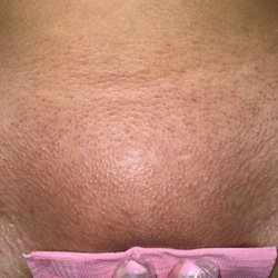 Bare It All Waxing - After photo of the same client with a closer angle.